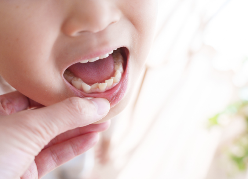 一生モノの財産を成長期のお子様に|くつい歯科