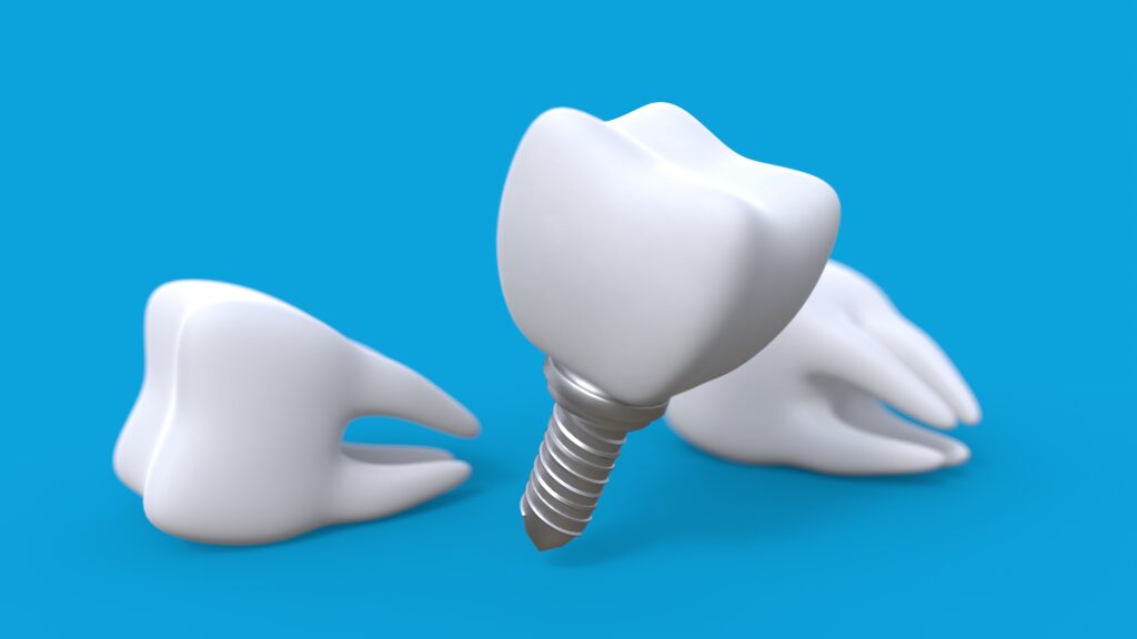 インプラントの模型