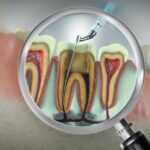 根管治療について調べるイメージ