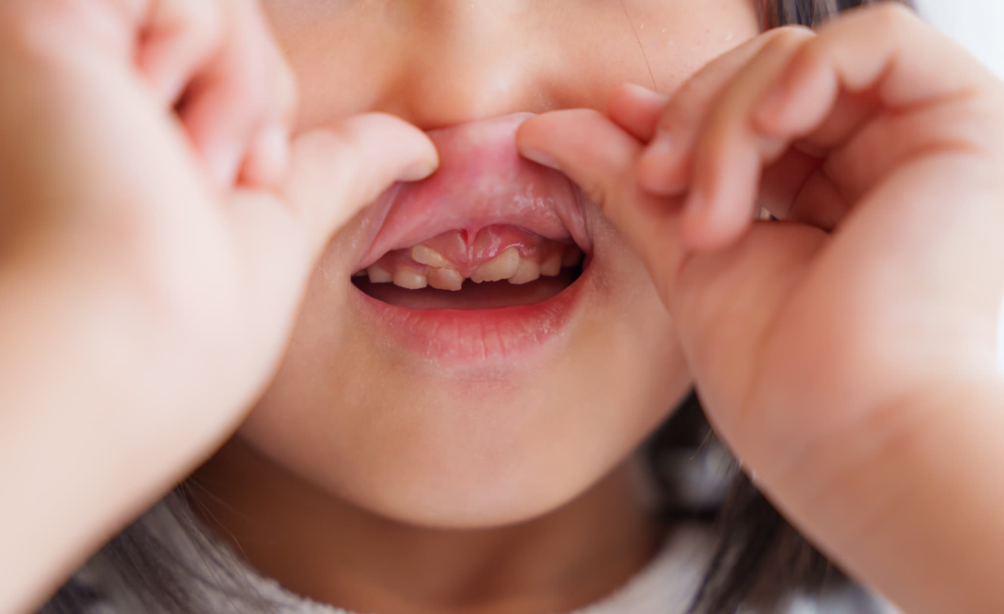 矯正が必要な子供の歯並び