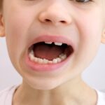 歯並びが悪い男の子の口