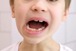歯並びが悪い男の子の口