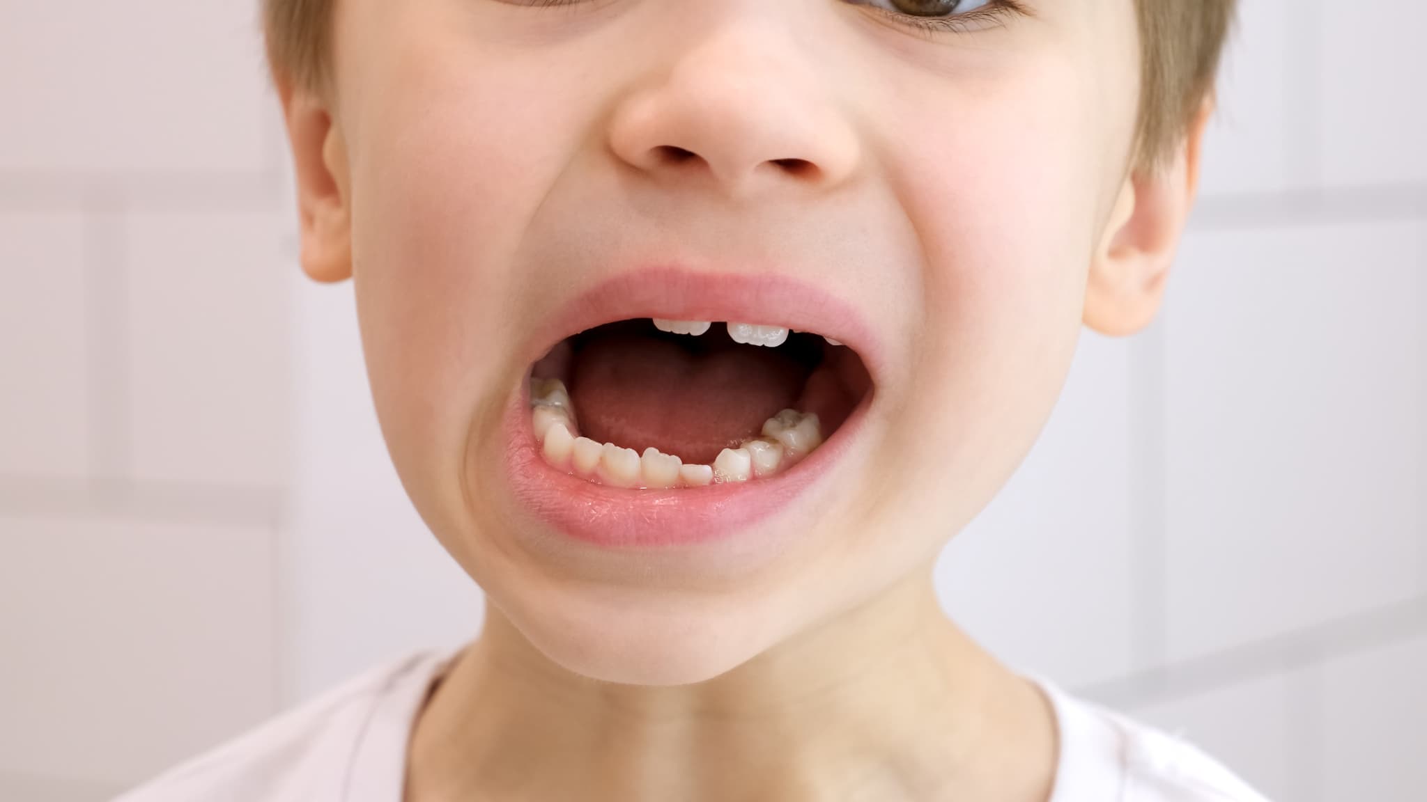 歯並びが悪い男の子の口