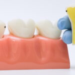 初期虫歯について模型で説明する歯科医