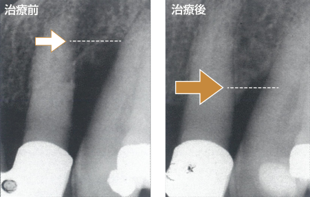 再生を成功させるための重要な期間|くつい歯科