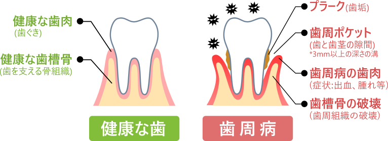 歯周病|くつい歯科