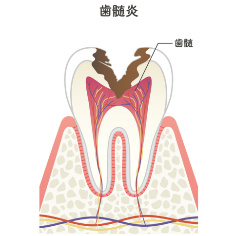 歯髄炎｜くつい歯科