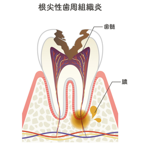 根尖性歯周炎｜くつい歯科