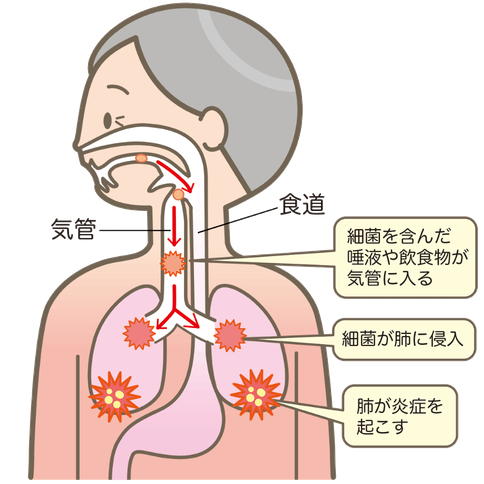 誤嚥性肺炎の予防｜くつい歯科