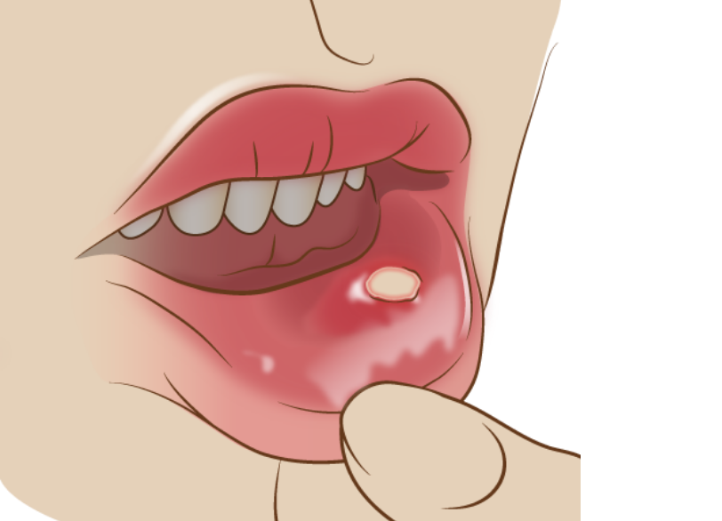 口内炎・粘膜疾患|くつい歯科