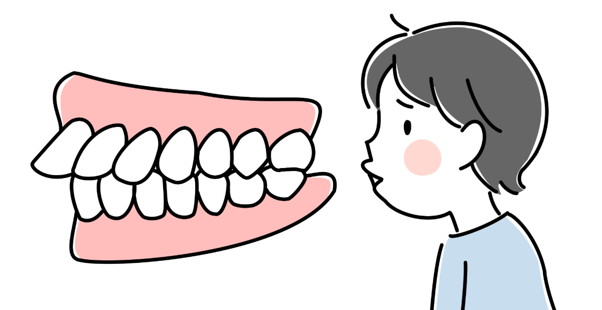 子どもの出っ歯の構造